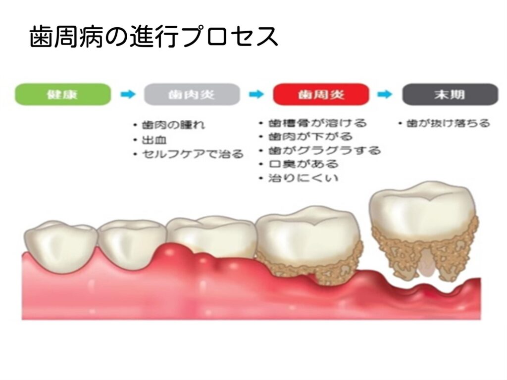 歯周病の進行プロセスのイメージ図