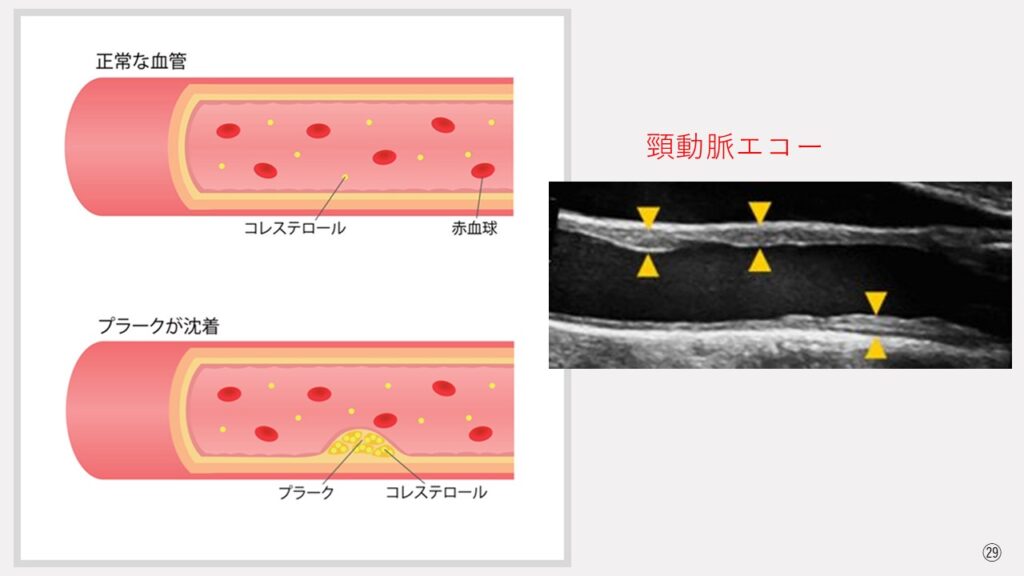 頸動脈エコーについて