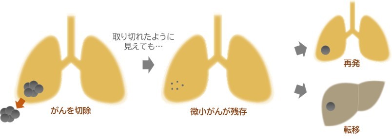 微小な残存がんが血液やリンパ液の流れに乗って他臓器へと運ばれ、遠隔転移をきたしてしまう例のイメージ