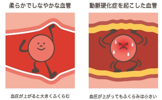 柔らかでしなやかな血管と動脈硬化症を起こした血管